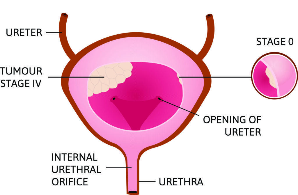 Prostate Ultrasound And Biopsy in Brooklyn, NY